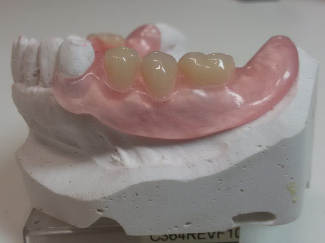 Protesi In Nylon Pro E Contro Protesi rimovibile flessibile in Nylon 📍 | 3D Lab