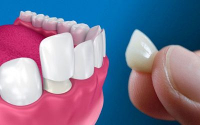 Faccette dentali. Quali caratteristiche e vantaggi 📍