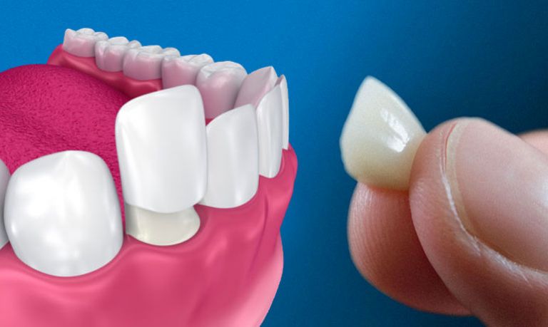 Faccette dentali. Quali caratteristiche e vantaggi 📍